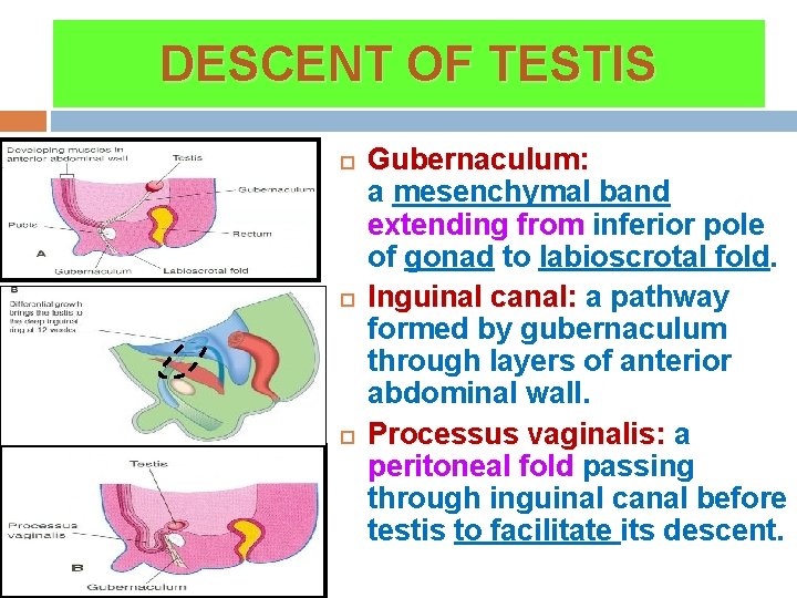 DESCENT OF TESTIS Gubernaculum: a mesenchymal band extending from inferior pole of gonad to