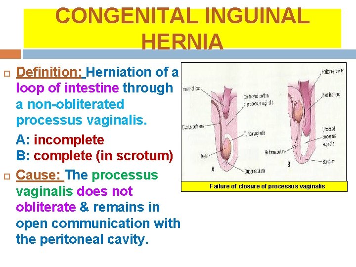 CONGENITAL INGUINAL HERNIA Definition: Herniation of a loop of intestine through a non-obliterated processus