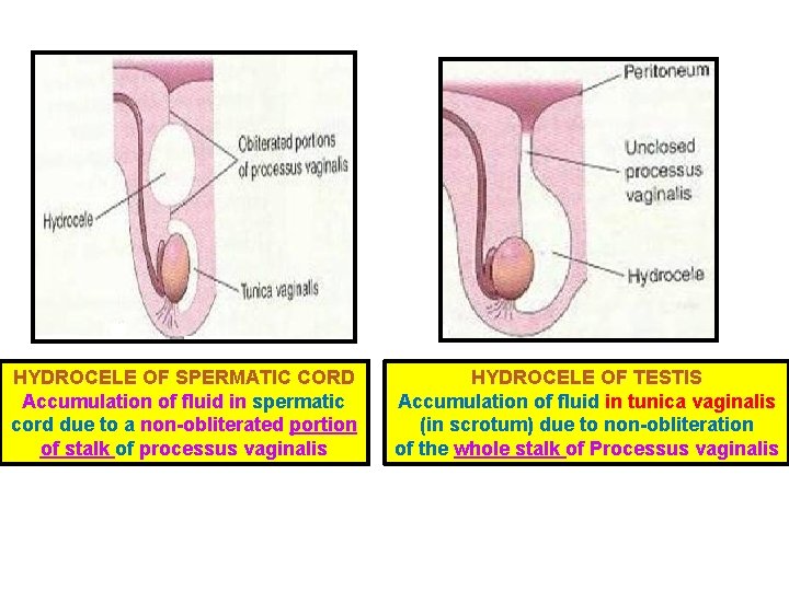 HYDROCELE OF SPERMATIC CORD Accumulation of fluid in spermatic cord due to a non-obliterated