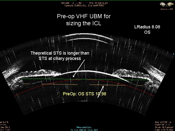 Pre-op VHF UBM for sizing the ICL Theoretical STS is longer than STS at Pre-op VHF UBM for sizing the ICL Theoretical STS is longer than STS at