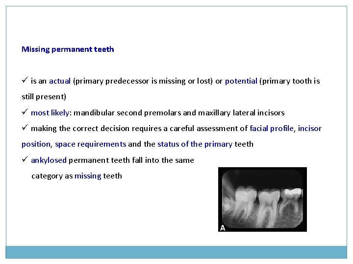 Missing permanent teeth ü is an actual (primary predecessor is missing or lost) or Missing permanent teeth ü is an actual (primary predecessor is missing or lost) or