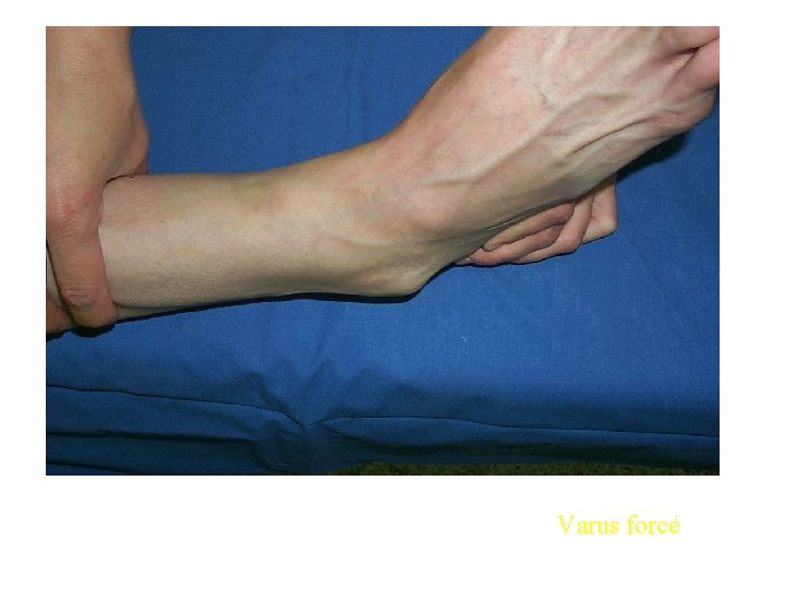 Varus forcé 