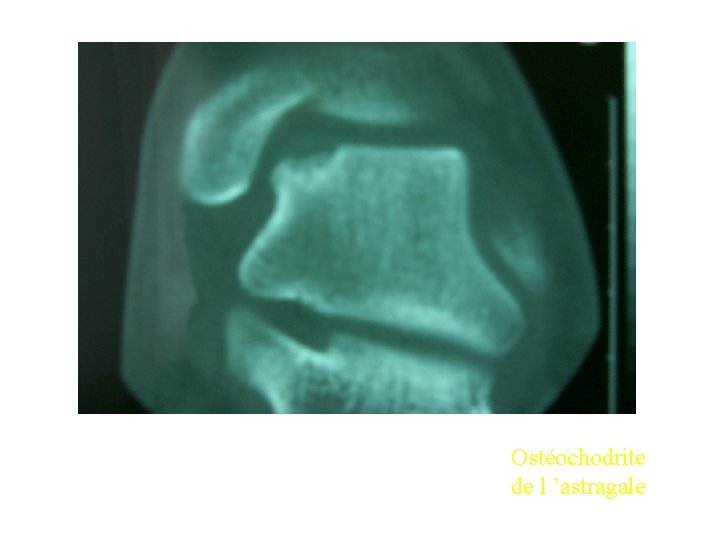 Ostéochodrite de l ’astragale 