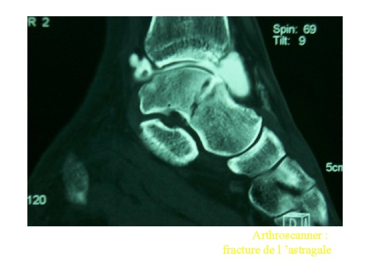 Arthroscanner : fracture de l ’astragale 