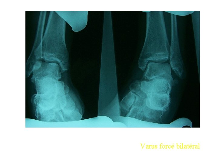 Varus forcé bilatéral 