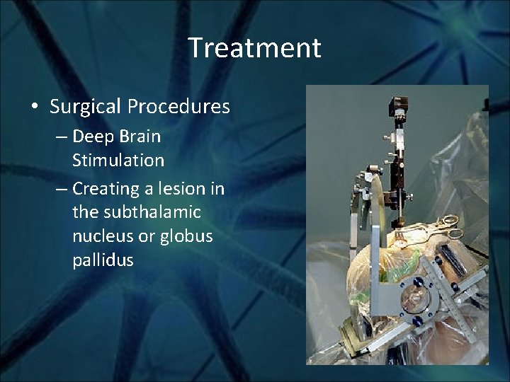 Treatment • Surgical Procedures – Deep Brain Stimulation – Creating a lesion in the