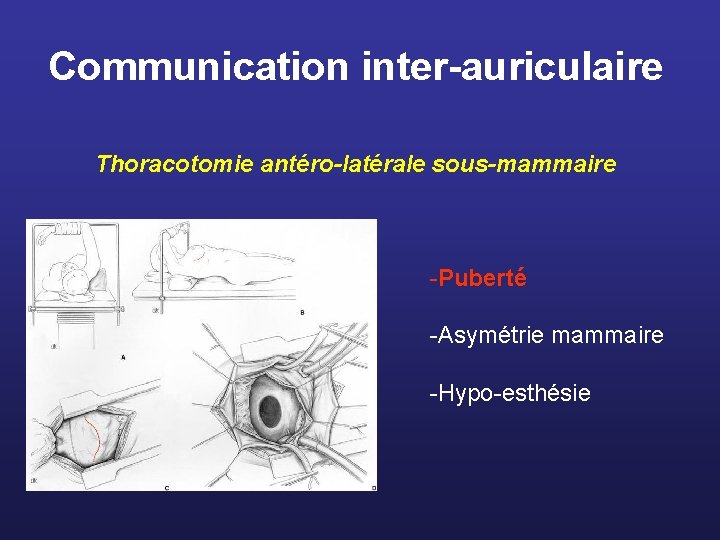 Communication inter-auriculaire Thoracotomie antéro-latérale sous-mammaire -Puberté -Asymétrie mammaire -Hypo-esthésie 