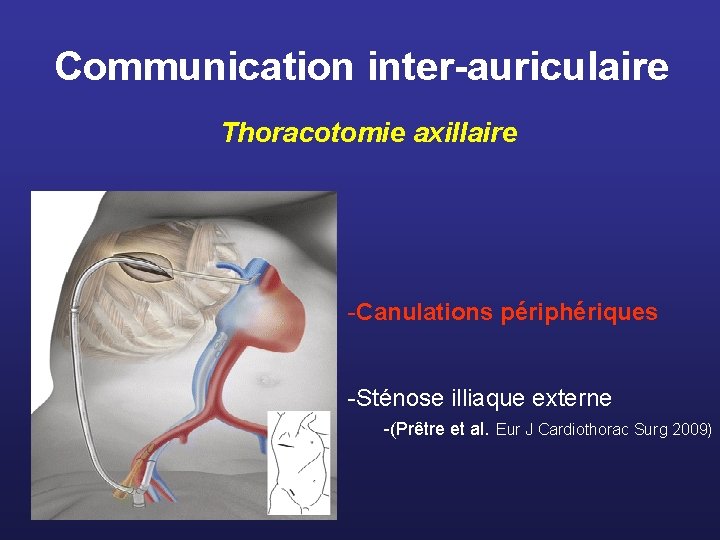 Communication inter-auriculaire Thoracotomie axillaire -Canulations périphériques -Sténose illiaque externe -(Prêtre et al. Eur J