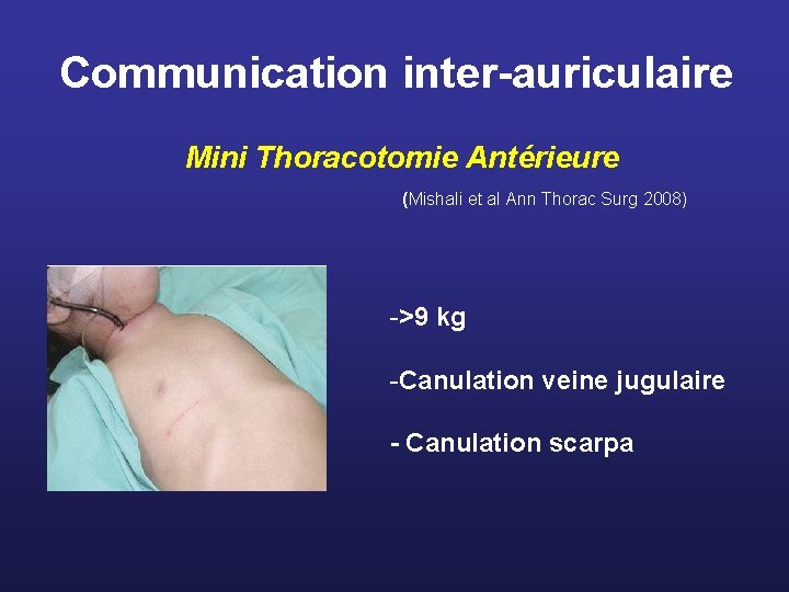 Communication inter-auriculaire Mini Thoracotomie Antérieure (Mishali et al Ann Thorac Surg 2008) ->9 kg