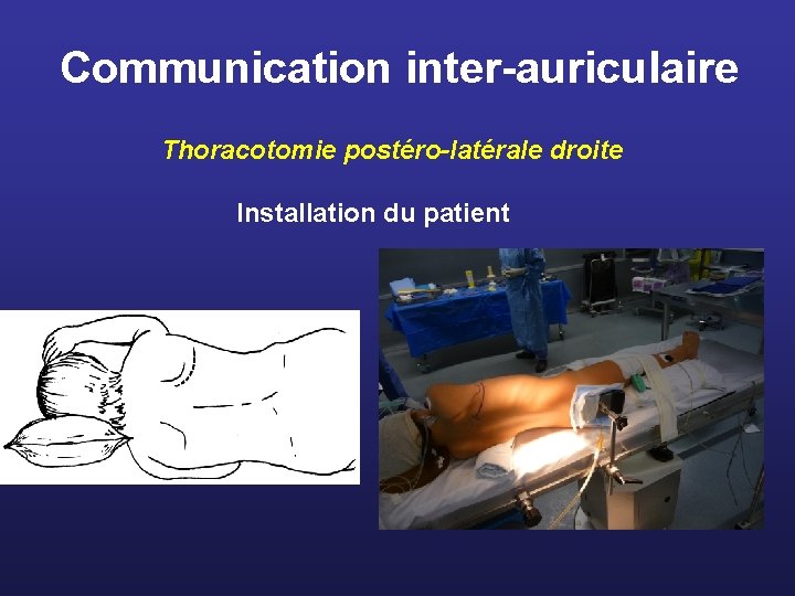 Communication inter-auriculaire Thoracotomie postéro-latérale droite Installation du patient 