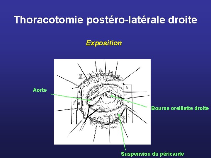 Thoracotomie postéro-latérale droite Exposition Aorte Bourse oreillette droite Suspension du péricarde 