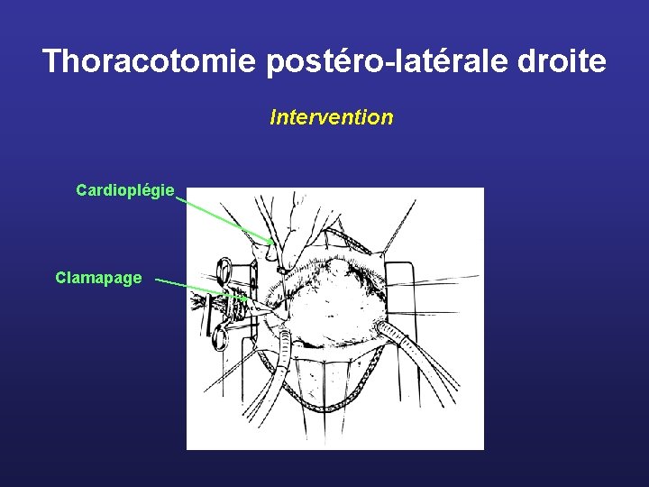 Thoracotomie postéro-latérale droite Intervention Cardioplégie Clamapage 