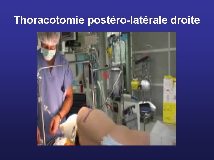 Thoracotomie postéro-latérale droite 