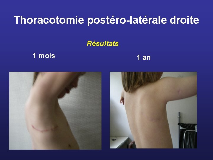 Thoracotomie postéro-latérale droite Résultats 1 mois 1 an 