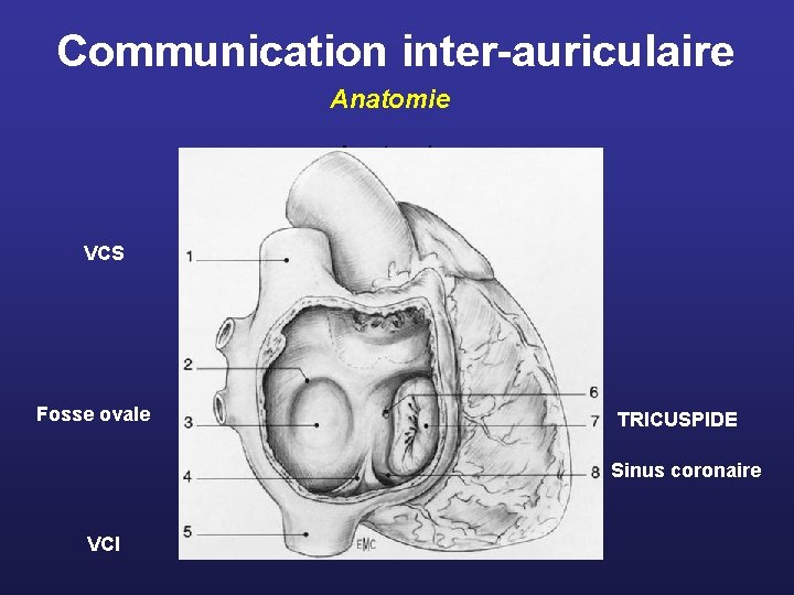 Communication inter-auriculaire Anatomie VCS Fosse ovale TRICUSPIDE Sinus coronaire VCI 