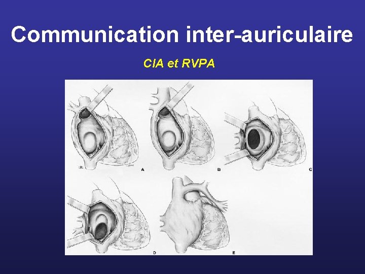 Communication inter-auriculaire CIA et RVPA 