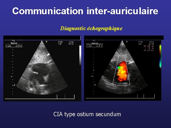 Communication inter-auriculaire Diagnostic échographique CIA type ostium secundum 