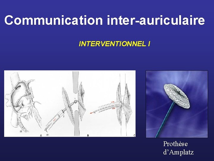 Communication inter-auriculaire INTERVENTIONNEL I Prothèse d’Amplatz 
