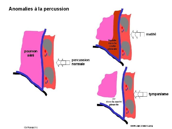 Anomalies à la percussion 