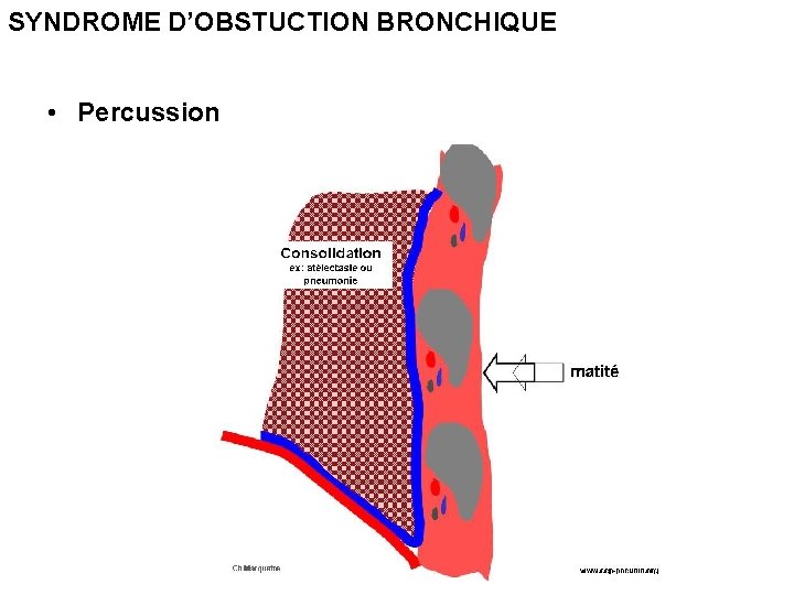 SYNDROME D’OBSTUCTION BRONCHIQUE • Percussion 