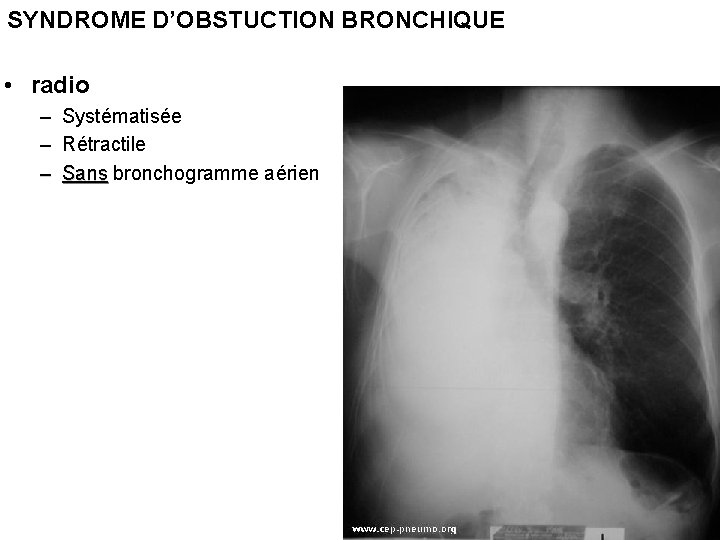 SYNDROME D’OBSTUCTION BRONCHIQUE • radio – Systématisée – Rétractile – Sans bronchogramme aérien 