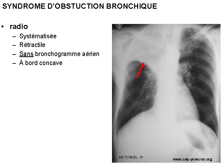 SYNDROME D’OBSTUCTION BRONCHIQUE • radio – – Systématisée Rétractile Sans bronchogramme aérien À bord