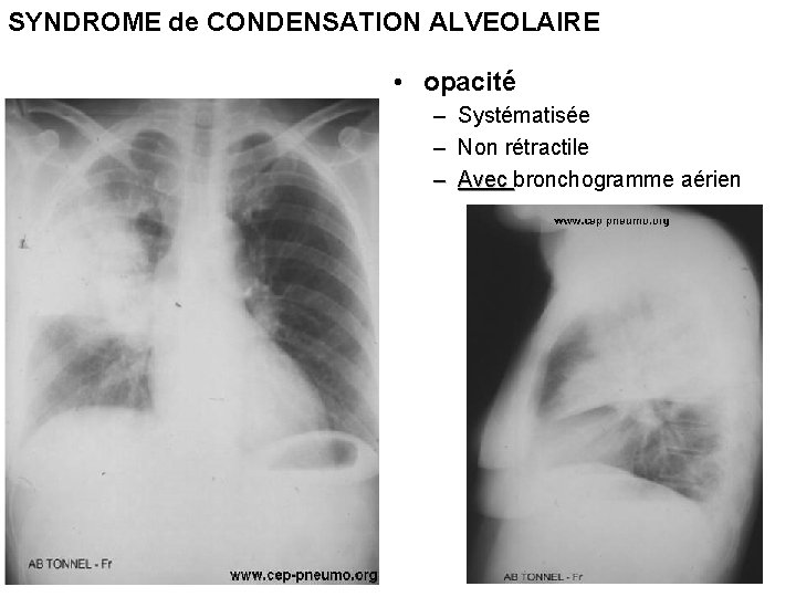 SYNDROME de CONDENSATION ALVEOLAIRE • opacité – Systématisée – Non rétractile – Avec bronchogramme