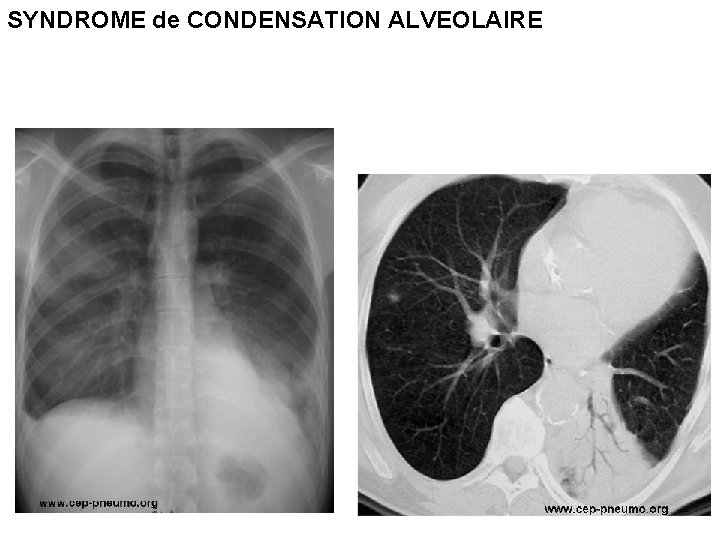 SYNDROME de CONDENSATION ALVEOLAIRE 