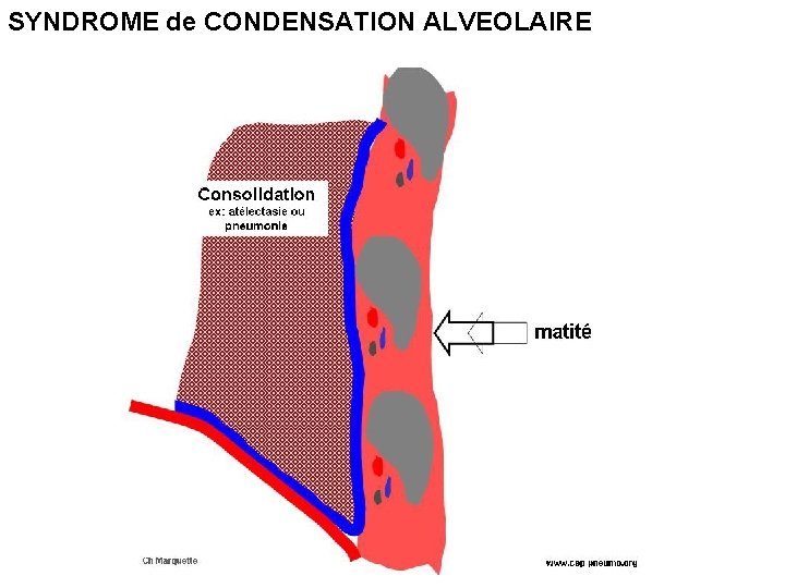 SYNDROME de CONDENSATION ALVEOLAIRE 