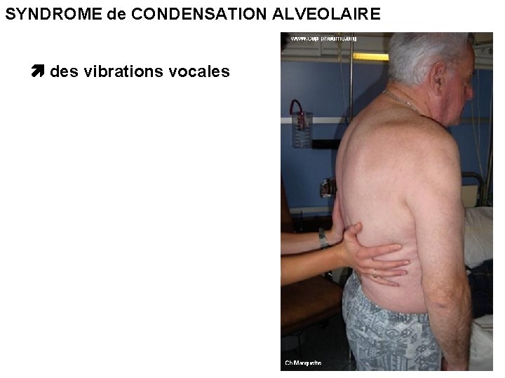 SYNDROME de CONDENSATION ALVEOLAIRE des vibrations vocales 