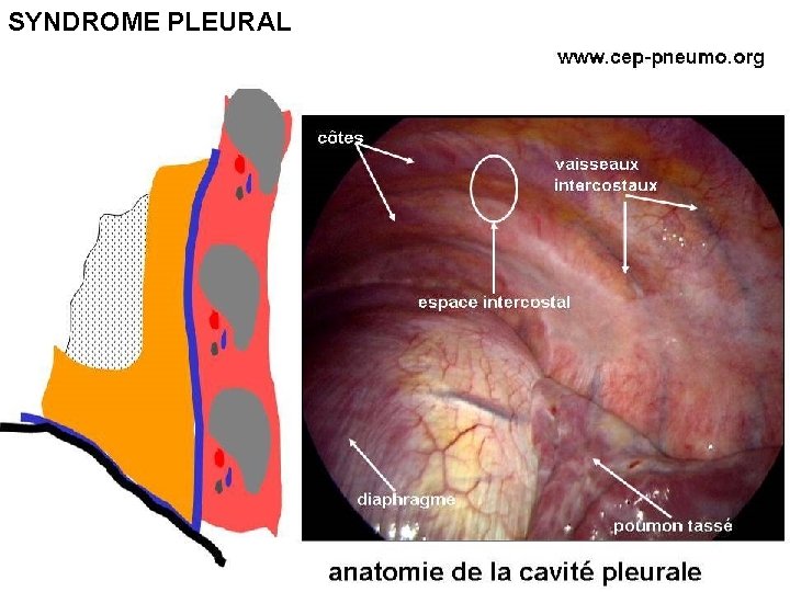 SYNDROME PLEURAL 