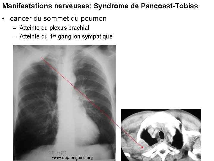 Manifestations nerveuses: Syndrome de Pancoast-Tobias • cancer du sommet du poumon – Atteinte du Manifestations nerveuses: Syndrome de Pancoast-Tobias • cancer du sommet du poumon – Atteinte du