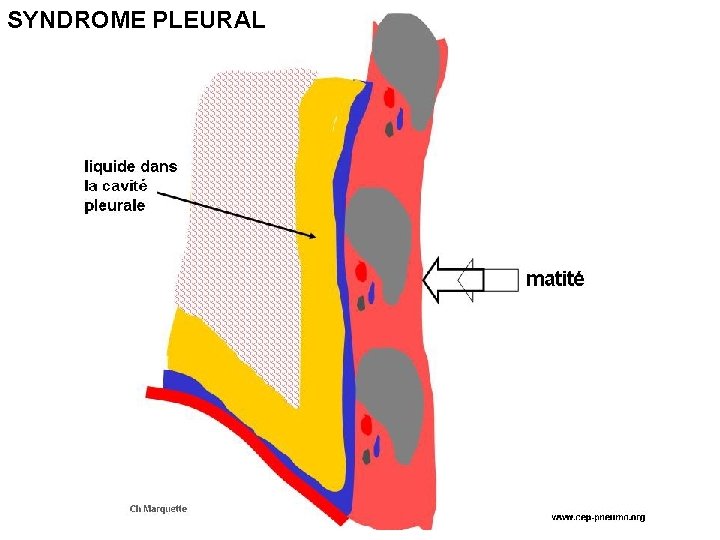 SYNDROME PLEURAL 