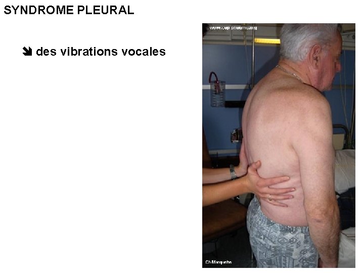 SYNDROME PLEURAL des vibrations vocales SYNDROME PLEURAL des vibrations vocales
