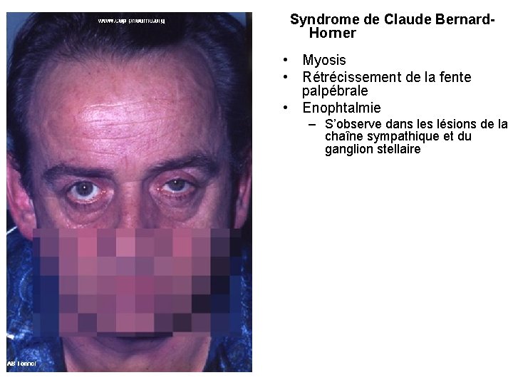 Syndrome de Claude Bernard. Horner • Myosis • Rétrécissement de la fente palpébrale • Syndrome de Claude Bernard. Horner • Myosis • Rétrécissement de la fente palpébrale •