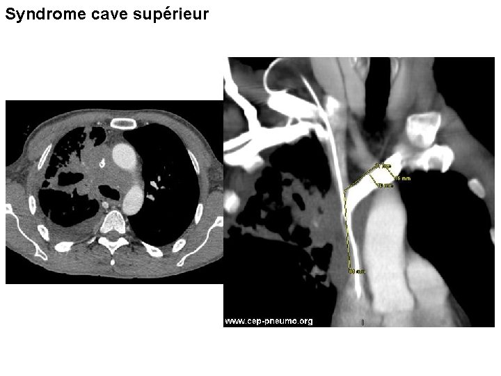 Syndrome cave supérieur 