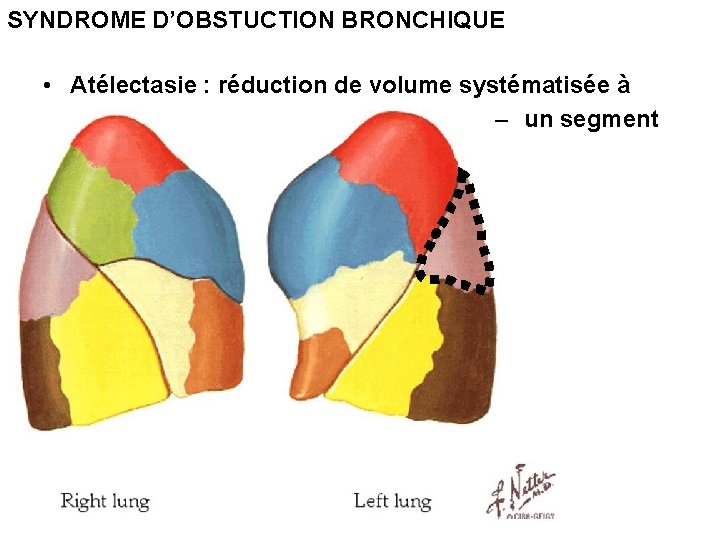SYNDROME D’OBSTUCTION BRONCHIQUE • Atélectasie : réduction de volume systématisée à – un segment SYNDROME D’OBSTUCTION BRONCHIQUE • Atélectasie : réduction de volume systématisée à – un segment