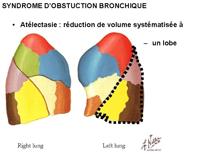 SYNDROME D’OBSTUCTION BRONCHIQUE • Atélectasie : réduction de volume systématisée à – un lobe
