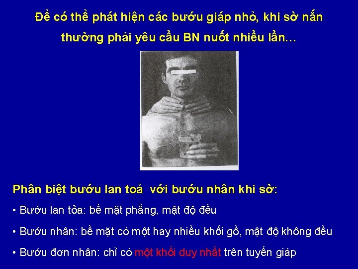 Để có thể phát hiện các bướu giáp nhỏ, khi sờ nắn thường phải