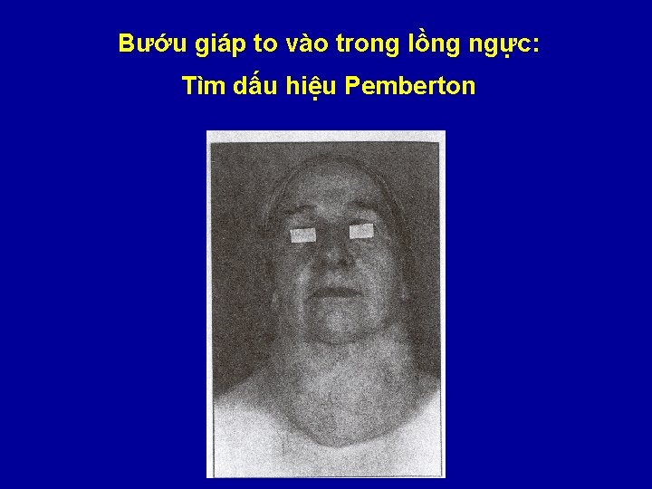 Bướu giáp to vào trong lồng ngực: Tìm dấu hiệu Pemberton 