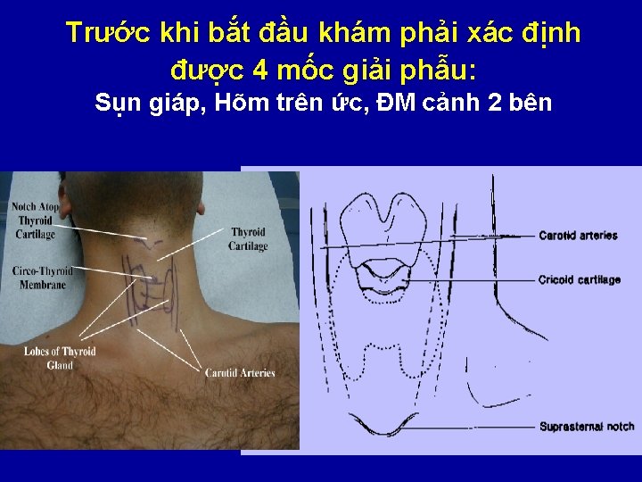 Trước khi bắt đầu khám phải xác định được 4 mốc giải phẫu: Sụn