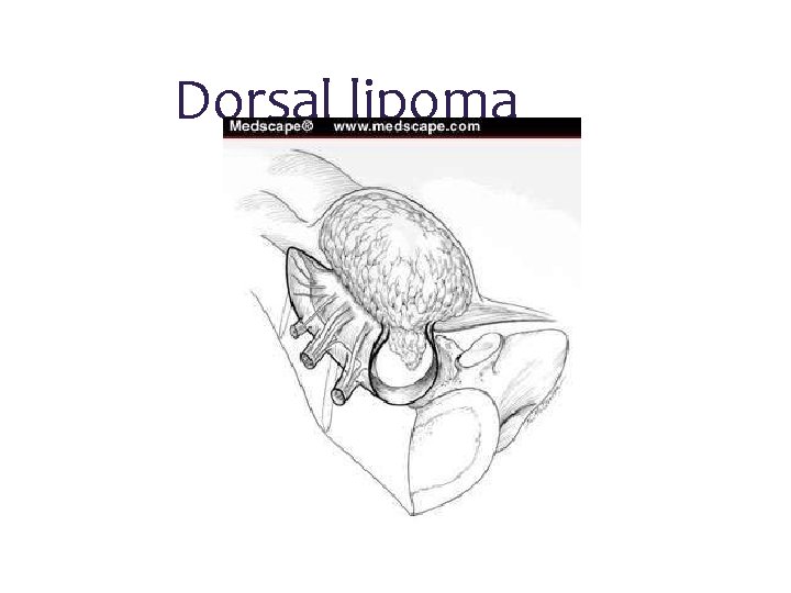 Dorsal lipoma 