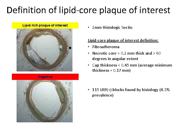 Definition of lipid-core plaque of interest Lipid rich plaque of interest • 2 mm