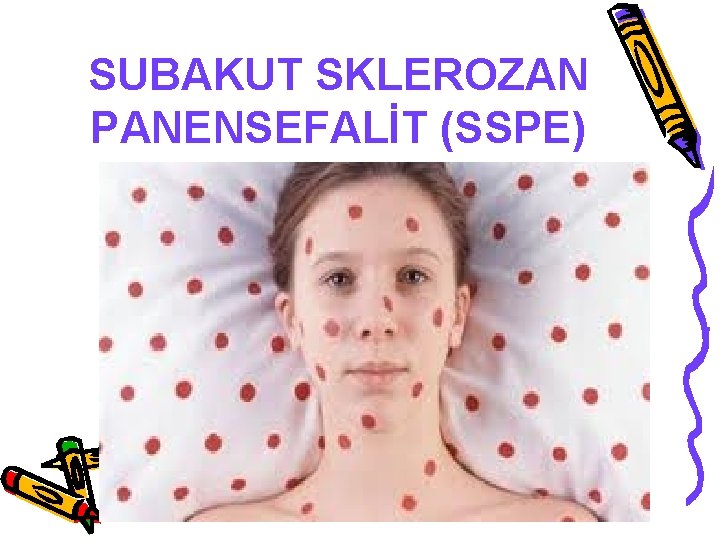 SUBAKUT SKLEROZAN PANENSEFALİT (SSPE) 