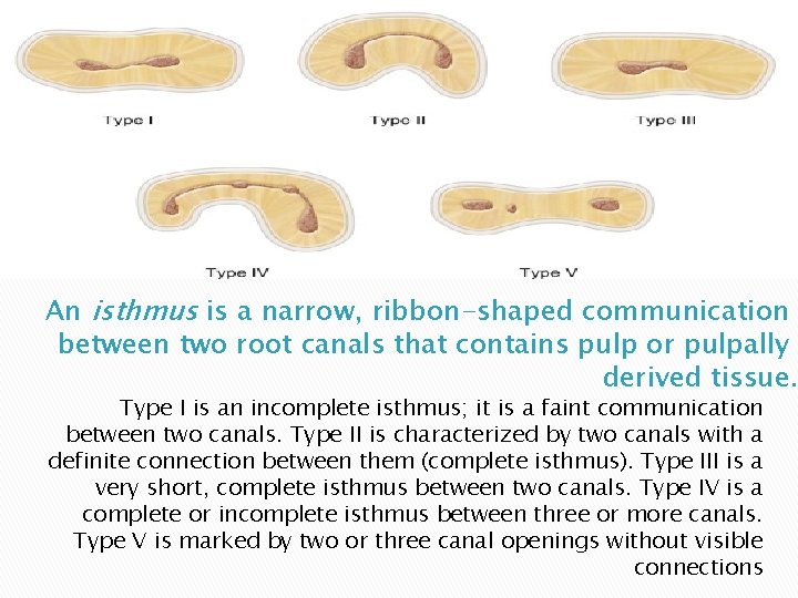 An isthmus is a narrow, ribbon-shaped communication between two root canals that contains pulp