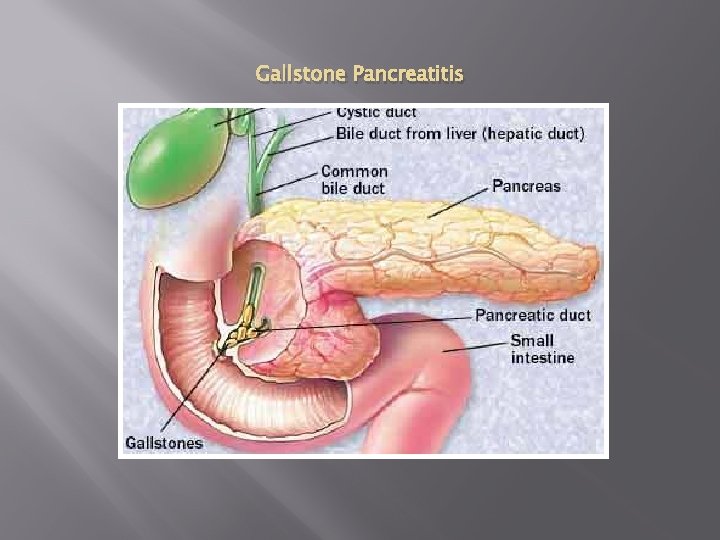 Gallstone Pancreatitis 