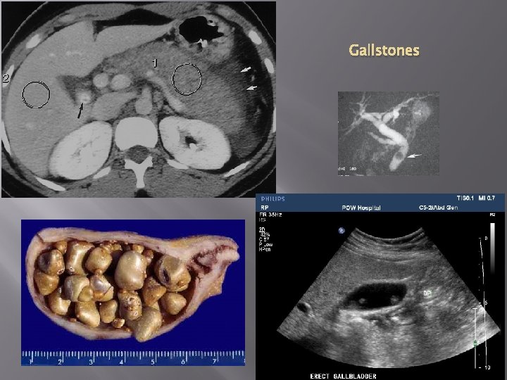 Gallstones 