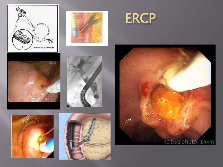 ERCP 