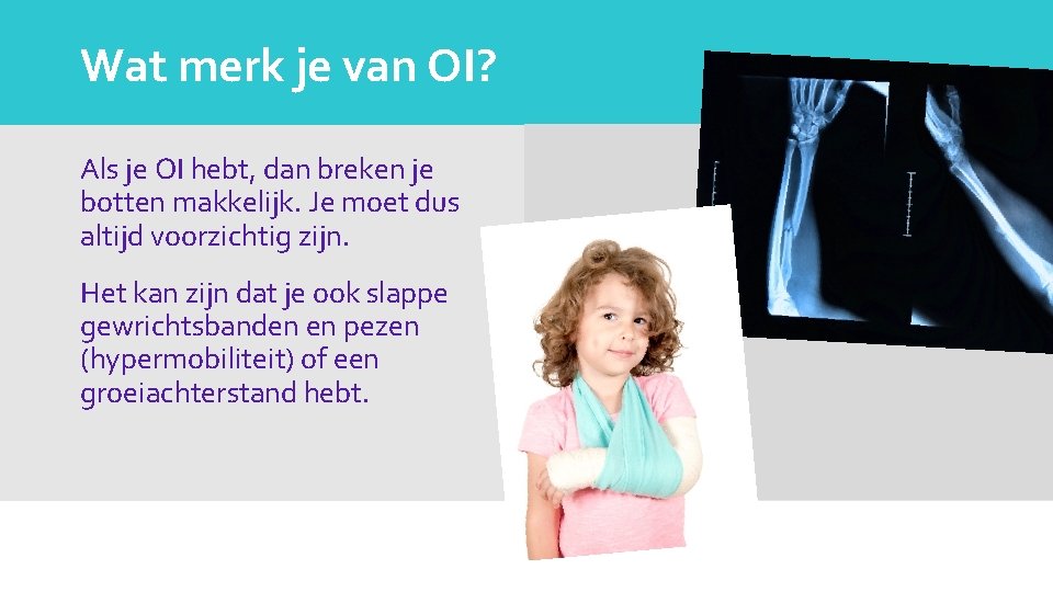 Wat merk je van OI? Als je OI hebt, dan breken je botten makkelijk.