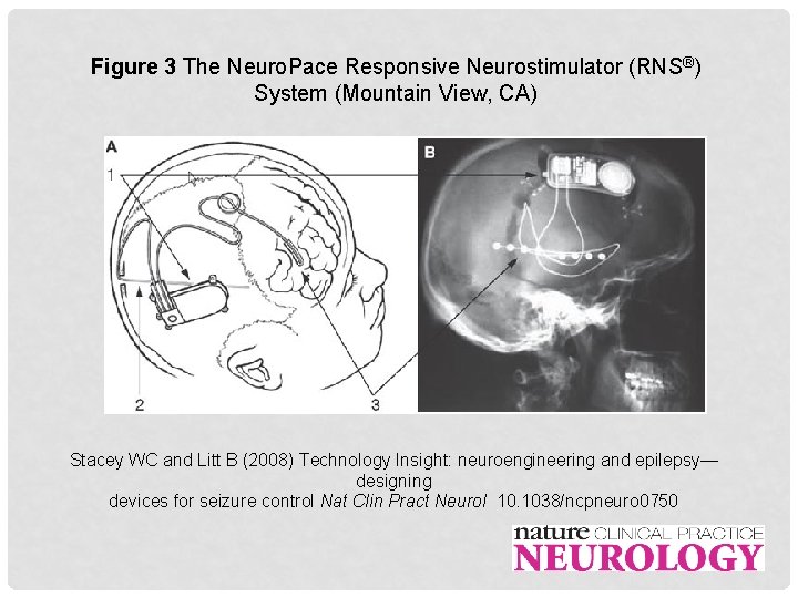 Figure 3 The Neuro. Pace Responsive Neurostimulator (RNS®) System (Mountain View, CA) Stacey WC